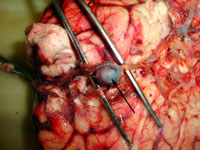 Мешотчатая аневризма развилки средней мозговой артерии