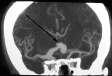 Фузиформная аневризма правой внутренней сонной и передней мозговой артерий при КТ-ангиографии