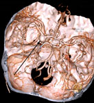 Мешотчатая аневризма развилки левой внутренней сонной артерии при КТ-ангиографии