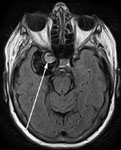 Аневризма правой внутренней сонной артерии при МРТ