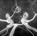 Аневризма передней соединительной артерии при МР-ангиографии