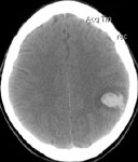 Применение нейронавигации в хирургии АВМ: внутримозговая гематома при КТ