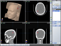Применение нейронавигации в хирургии АВМ: планирование доступа к гематоме при помощи компьютера
