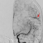 Тотальная эмболизация АВМ левой височной доли ониксом: каротидная ангиограмма после эмболизации