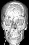 3D КТ: множественные переломы костей черепа