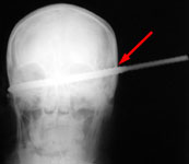 Колотая рана головы, проникающая в полость передней черепной ямки: рентгенограмма в прямой проекции