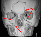 Множественные переломы костей лица: 3D КТ в прямой проекции
