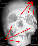 Множественная черепно-лицевая травма: КТ в прямой проекции до операции