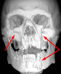 Множественная черепно-лицевая травма: 3D-КТ