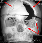 КТ до операции: сочетанное черепно-лицевое повреждение
