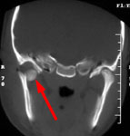 КТ в коронарной проекции: перелом головки правого мыщелкового отростка со смещением