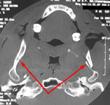 Перелом мыщелковых (суставных) отростков нижней челюсти: КТ в аксиальной проекции
