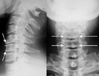 Дегенеративно-дистрофическое поражение шейного отдела позвоночника и секвестрированная грыжа диска С5-6: рентгенограмма в боковой и прямой проекции