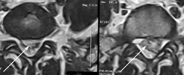 Больная после микрохирургического удаления левосторонней секвестрированной грыжи диска L5-S1 и полным выздоровлением: МРТ в аксиальной проекции до операции