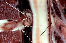 Анатомический препарат компрессии спинного мозга секвестром диска