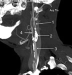 Стеноз сонных артерий при КТ-ангиографии
