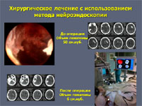 Нейроэндоскопия при геморрагическом инсульте
