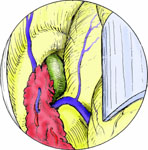 Удаление коллоидной кисты третьего желудочка, вызывающей окклюзионную гидроцефалию: ход операции