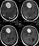 Удаление крупной менингиомой ольфакторной ямки: МРТ до операции