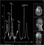 Удаление анапластической астроцитомы правой височной доли: МР-спектрография